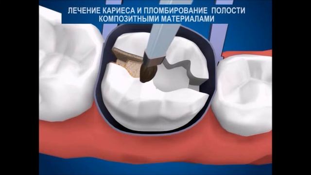 Как лечить зубы композитными (пластмассовыми) материалами. Терапевтическая стоматология. смотреть онлайн