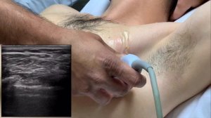 PECS 1, 2, Serratus, and Pecto-Intercostal Blocks