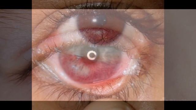 Ячмень у ребенка