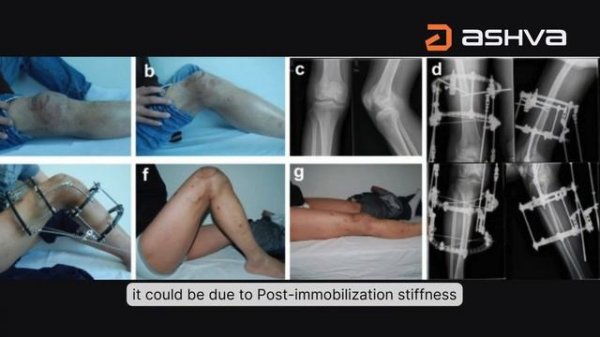 Reasons for a knee flexion deficit!!