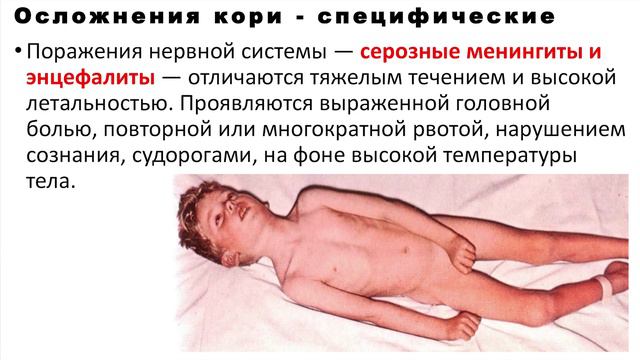 Корь — какая она и какие неприятности возможны? смотреть онлайн