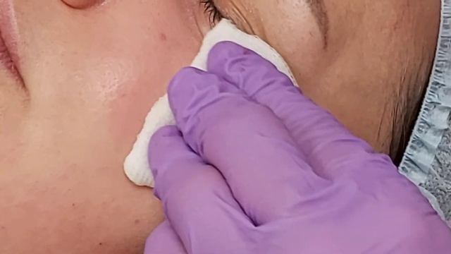 Мезотерапия. Инъекции при темных кругах под глазами. смотреть онлайн