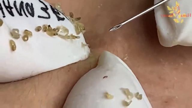 Relax Every Day With Loan Nguyen Spa | Acne Treatment Pimple Popping #2 смотреть онлайн