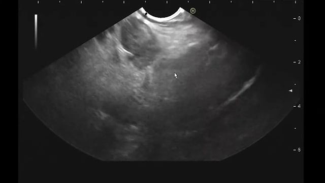 EUS-guided biopsy of lymph node to rule out lymphoma смотреть онлайн