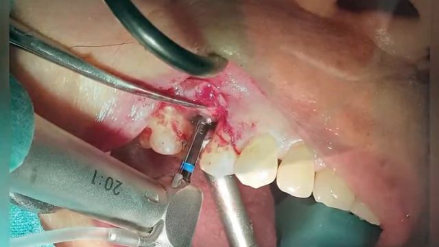 Placement of Dental Implant with Crestal Sinus Lift смотреть онлайн