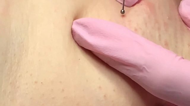 Удаление бородавок смотреть онлайн