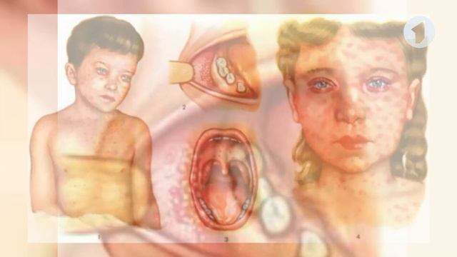 Что такое корь / Здравствуйте смотреть онлайн