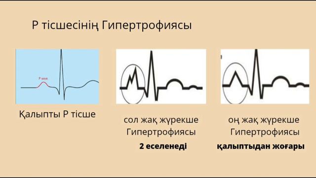 ЭКГ🫀. Жүректің Гипертрофиясы.2 сабақ. смотреть онлайн
