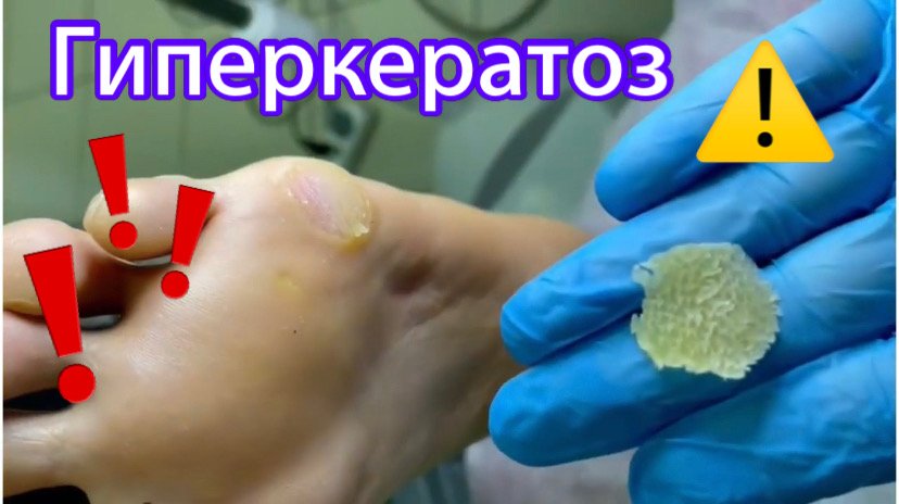 Гиперкератоз ??⚠️❗️? смотреть онлайн