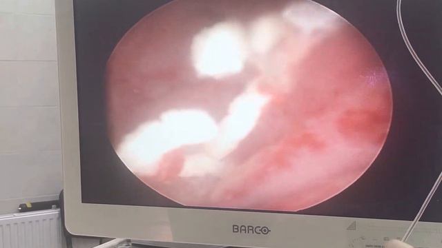 Удаление шовных лигатур из полости матки. смотреть онлайн