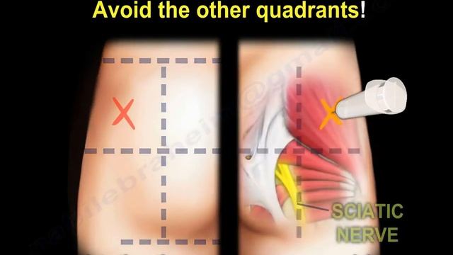 Glute Injection - Everything You Need To Know - Dr. Nabil Ebraheim