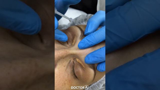 Лазерное удаление ксантелазм! До и сразу после удаления!