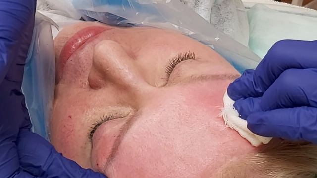 Лифтинг бровей. Нити Cog, мезонити Tornado, для выравнивания кожи лба. смотреть онлайн