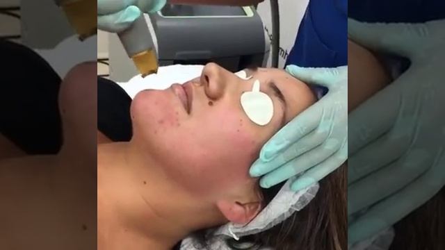 Cutera Laser Genesis смотреть онлайн