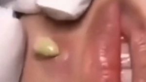 ? CRAZY PIMPLES POPPING COMPILATION ? | Best CYST REVEAL of week | part 3