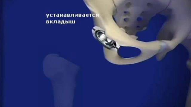 эндопротезирование тазобедренного сустава.flv смотреть онлайн