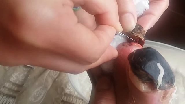 процесс восстановления после обморожения, слабонервным не смотреть! смотреть онлайн