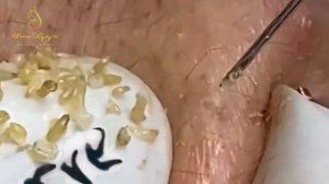 Relax squeezing out blackheads# 3 Черные точки