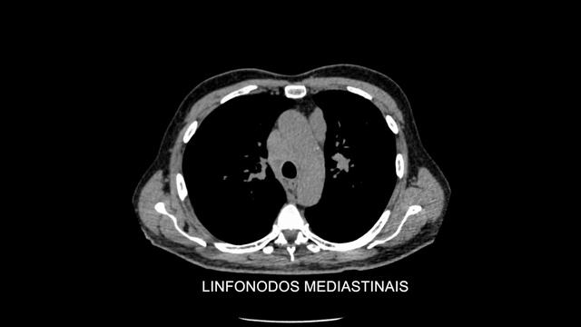 Lung Cancer -Left lower lobe mass and lymph nodes/ Massa pulmonar Esquerda смотреть онлайн