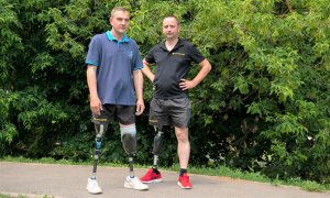 Более 20-ти лет ходит на протезе бедра