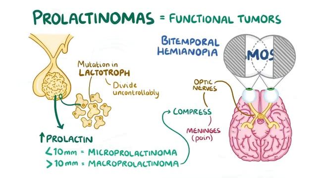 Prolactinoma - causes, symptoms, diagnosis, treatment, pathology.mp4 смотреть онлайн