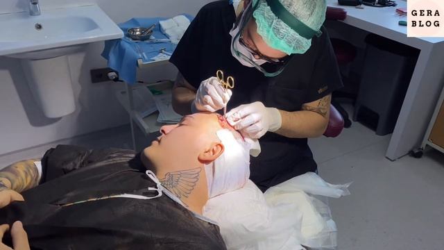 ПЕРЕСАДКА ВОЛОС. Результат ДО и ПОСЛЕ. Стамбул? смотреть онлайн