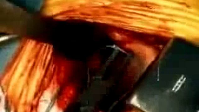 Traumatic Instability of the Shoulder: Angled needle holder смотреть онлайн