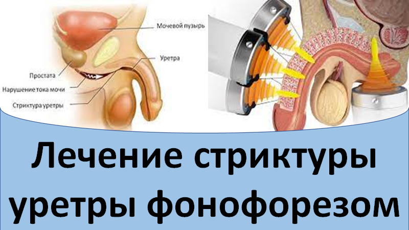 Лечение стриктуры уретры фонофорезом смотреть онлайн
