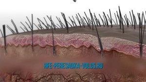 Пересадка волос методом DHI. Что такое метод DHI? На чем основан метод DHI и чем он лучше FUE?