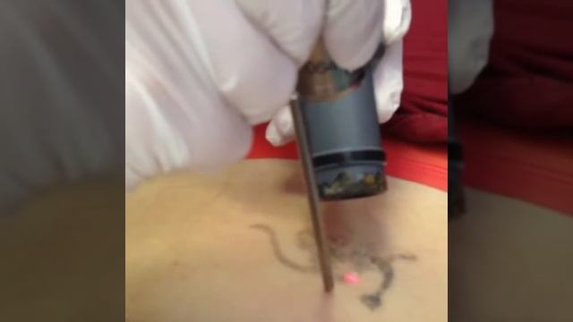 Удаление татуировок лазером смотреть онлайн