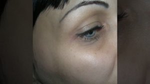 БОТОКС и БИОРЕВИТАЛИЗАЦИЯ - вокруг глаз - до и после