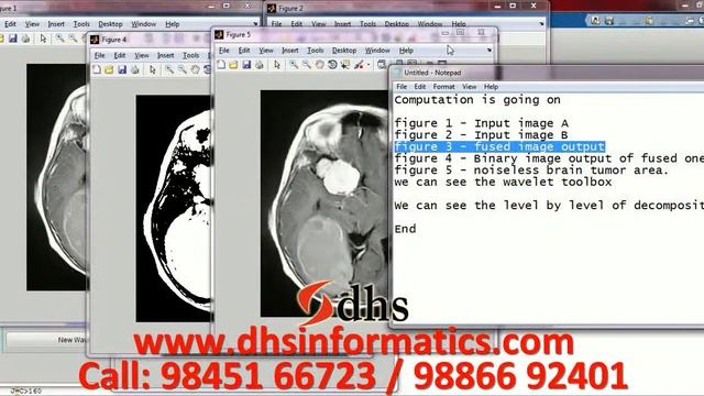 DHS MATLAB Projects Brain Tumor Detection from Clinical CT & MRI Image using WT FCM Algorithm смотреть онлайн