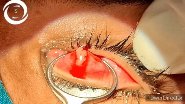 Chalazion surgery in topical anaesthesia смотреть онлайн