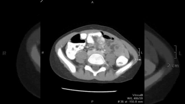 Ovarian torsion смотреть онлайн