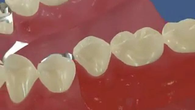 Бюгельный протезы смотреть онлайн