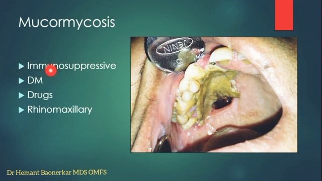 Oral Manifestations Of covid 19 / Oral signs of covid / Oral Surgery and beyond смотреть онлайн