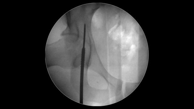 Retrograde locking nail for pubic bone osteosynthesis. Nsn™ смотреть онлайн