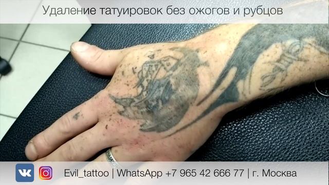 Как правильно удалять татуировку? смотреть онлайн
