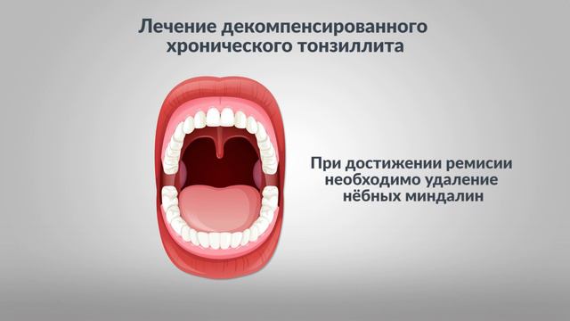 Тонзиллит. Показания к тонзиллэктомии.