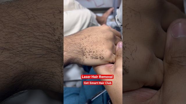 laser hair removal смотреть онлайн