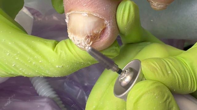 Отдавили ноготь / Как прирастить ноготь? Болит ноготь #ноготь #подолог #медицинскийпедикюр #ногти