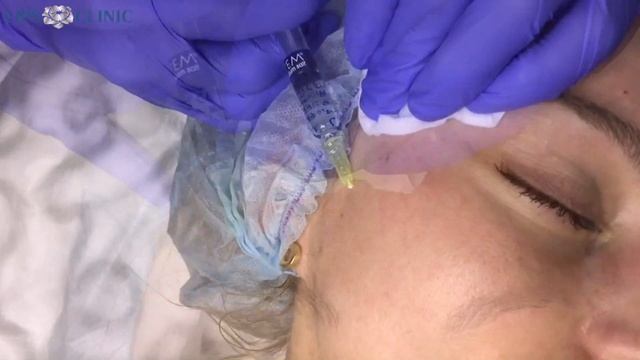 Биоревитализация IAL SISTEM смотреть онлайн