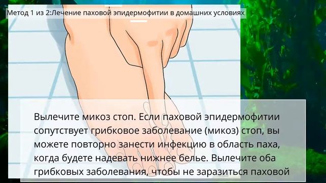Как лечить паховую эпидермофитию - Подзалу*ный творожок смотреть онлайн
