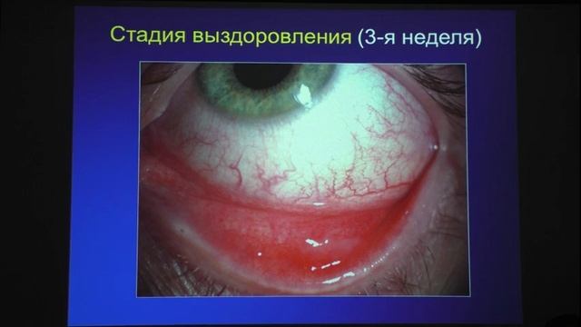 Ведение хронического рецидивирующего герпетического кератита смотреть онлайн