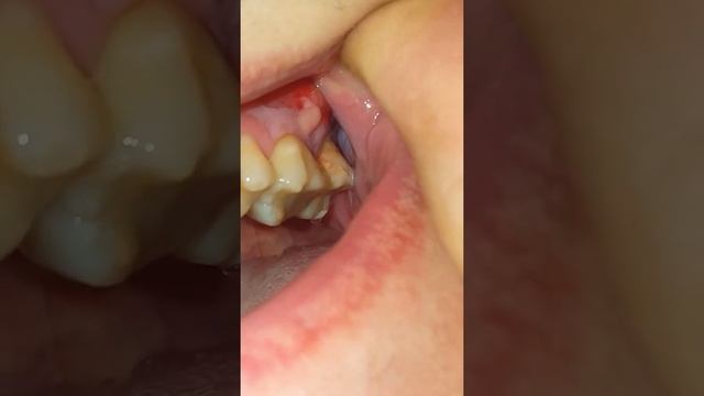 Вскрылся ,флюс ,гнойник ,над зубом. смотреть онлайн