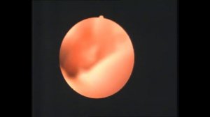 Удаление двух небольших полипов цервикального канала 9.11.2016.