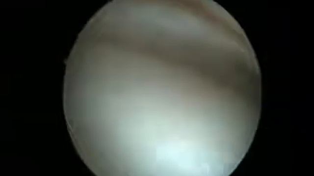 Артроскопия  Повреждение медиального мениска