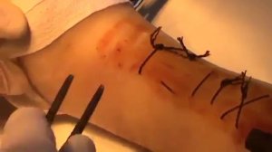 Снятие хирургических швов