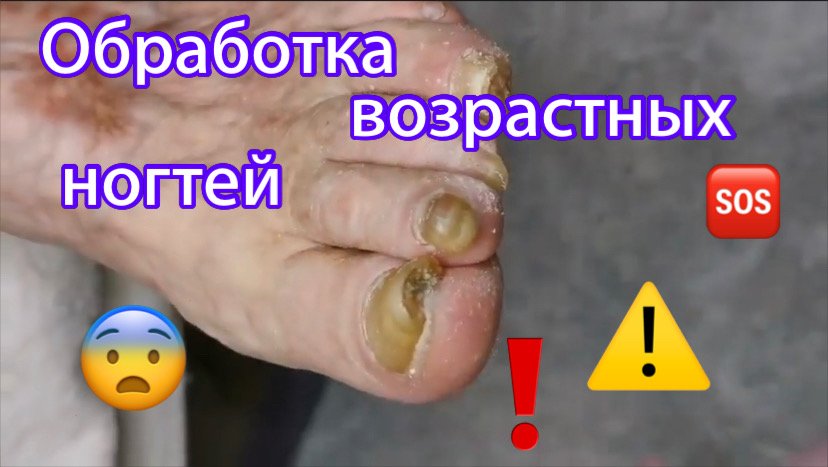 Обработка возрастных ногтей ⚠️?❗️?? смотреть онлайн