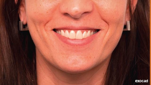 exocad DentalCAD 2.3 Matera with Smile Creator add-on module смотреть онлайн